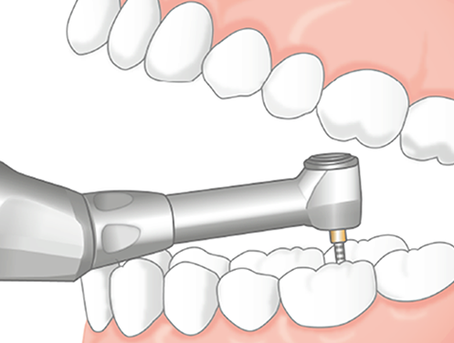 Handpiece Lubricant Device